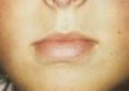 Lip augmentation - cheiloplasty - Photo before - Doc. MUDr. Jan Válka