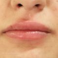 Lip augmentation (fat injection, lipofilling) - Photo before