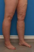 Varicose veins laser treatment - Photo before - MUDr. Jiřina Šilhánková