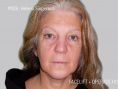 Facelift - Photo before - Asklepion – Laser and Aesthetic medicine