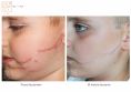Laser Scar Treatment - Photo before - Dr n. med. Marcin Bieńkowski