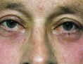 Eyelid surgery (Blepharoplasty) - Photo before - Asklepion – Laser and Aesthetic medicine