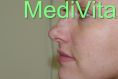 Hyaluronic acid-based wrinkle fillers - Photo before - lek. med. Jacek Ściborowicz - MediVita