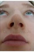 Rhinoplasty (Nose Job) - Photo before - Dr. med. Jozefina Skulavik