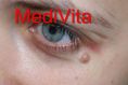 Laser skin tag removal - Photo before - lek. med. Jacek Ściborowicz - MediVita
