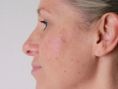 Age Spots Treatment - Photo before - Asklepion – Laser and Aesthetic medicine