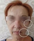 Ultherapy - Photo before - Eveclinic Bratislava