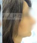 Liposuction - Photo before - MUDr. Jozef Fedeleš PhD.