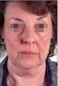 Ultherapy - Photo before - Eveclinic Bratislava