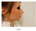 Rhinoplasty (Nose Job) - Photo before