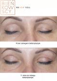 Eyelid surgery (Blepharoplasty) - Photo before - Dr n. med. Marcin Bieńkowski