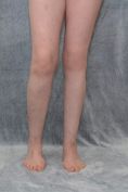 Varicose veins laser treatment - Photo before - MUDr. Jiřina Šilhánková