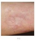 Scar removal - Photo before - Martin Molitor, MD, Ph.D., MBA