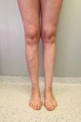 Varicose veins laser treatment - Photo before - MUDr. Jiřina Šilhánková