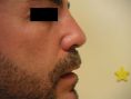 Rhinoplasty (Nose Job) - Photo before - MUDr. Libor Polák