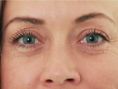 Hyaluronic acid-based wrinkle fillers - Photo before - Asklepion – Laser and Aesthetic medicine