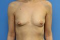 Breast Augmentation - Breast Implants - Photo before - MUDr. Jiřina Šilhánková