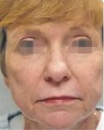 Ultherapy - Photo before - Eveclinic Bratislava