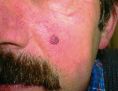 Laser skin tag removal - Photo before - Asklepion – Laser and Aesthetic medicine