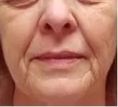 Ultherapy - Photo before - Eveclinic Bratislava