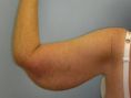Arm Lift Surgery - Photo before - Adam J. Rubinstein M.D., FACS
