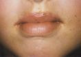 Lip augmentation - cheiloplasty - Photo before - Doc. MUDr. Jan Válka