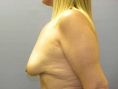 Breast Augmentation - Breast Implants - Photo before - Adam J. Rubinstein M.D., FACS