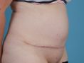 Abdominoplasty (Tummy Tucks) - Photo before - PRIMED Clinic
