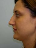 Rhinoplasty (Nose Job) - Photo before - Adam J. Rubinstein M.D., FACS