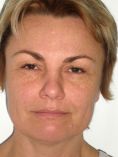 Brow lift - Photo before - Asklepion – Laser and Aesthetic medicine