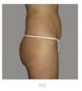 Liposuction - Photo before - Martin Molitor, MD, Ph.D., MBA