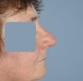 Rhinoplasty (Nose Job) - Photo before - Dr n. med. Lubomir Lembas