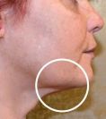 Ultherapy - Photo before - Eveclinic Bratislava