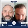 Hair Transplant - Photo before