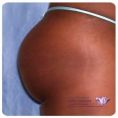 Buttock and calf plastic surgery - Photo before - Mr. Christopher Inglefield BSc, MBBS, FRCS(Plast)