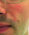 Laser skin tag removal - Photo before - Asklepion – Laser and Aesthetic medicine