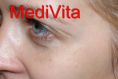 Mole removal - Photo before - lek. med. Jacek Ściborowicz - MediVita
