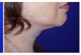 Chin Liposuction - Photo before - Dr. Albert Feichter