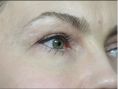 Dermal fillers - Photo before - Dr. med. Stephan Günther