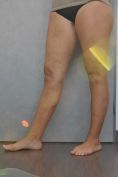 Varicose veins laser treatment - Photo before - MUDr. Jiřina Šilhánková