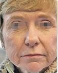 Ultherapy - Photo before - Eveclinic Bratislava