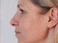 Age Spots Treatment - Photo before - Asklepion – Laser and Aesthetic medicine