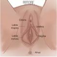 Labiaplasty (Labia Reduction) - Did you know that many women live with pain or reduced sexual pleasure and embarrassment due to a loosening of their vagina or an enlarged or misshapen labia, most often due to aging or childbirth.

While a growing number of women are motivated to improve their sex lives and feel better about themselves, many don’t know where to turn or may feel too embarrassed to discuss this issue with friends, family or even a health care provider. Our physicians want you to know that your health and well-being is their top priority. They have the experience, sensitivity and knowledge to help you.