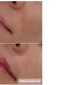 Lip augmentation - cheiloplasty - Photo before - MUDr. Diana Višňovská