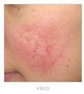 Mesotherapy (face, neck revitalization) - Photo before - Martin Molitor, MD, Ph.D., MBA
