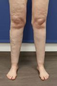 Varicose veins laser treatment - Photo before - MUDr. Jiřina Šilhánková