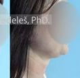 Chin Liposuction - Photo before - MUDr. Jozef Fedeleš PhD.