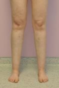 Varicose veins laser treatment - Photo before - MUDr. Jiřina Šilhánková