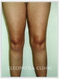 Liposuction - Photo before - Cleopatra Clinic, Klinika Plastické Chirurgie s.r.o.