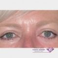Eyelid surgery (Blepharoplasty) - Photo before - Mr. Christopher Inglefield BSc, MBBS, FRCS(Plast)